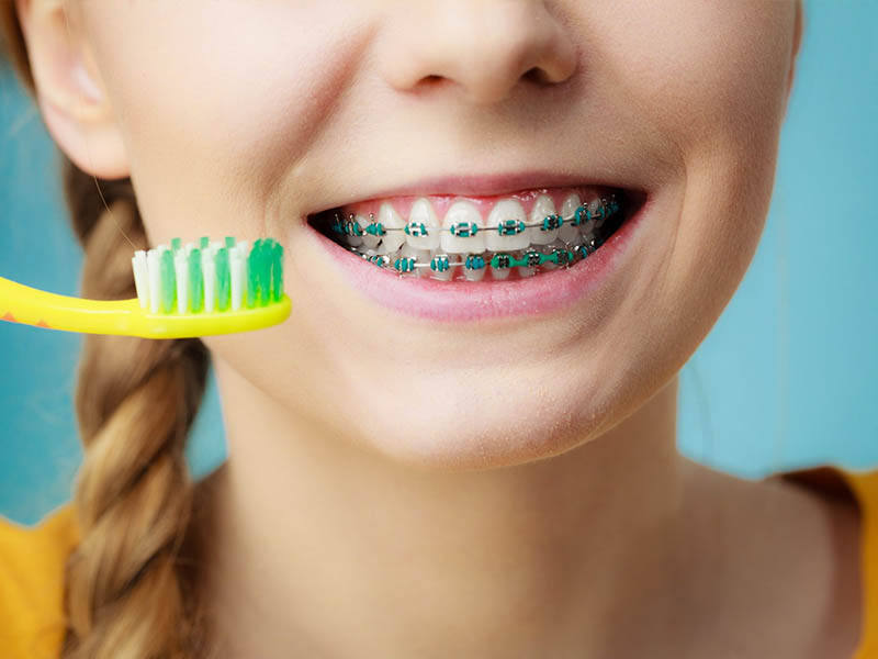 Hướng dẫn vệ sinh răng miệng đúng cách cho người niềng răng