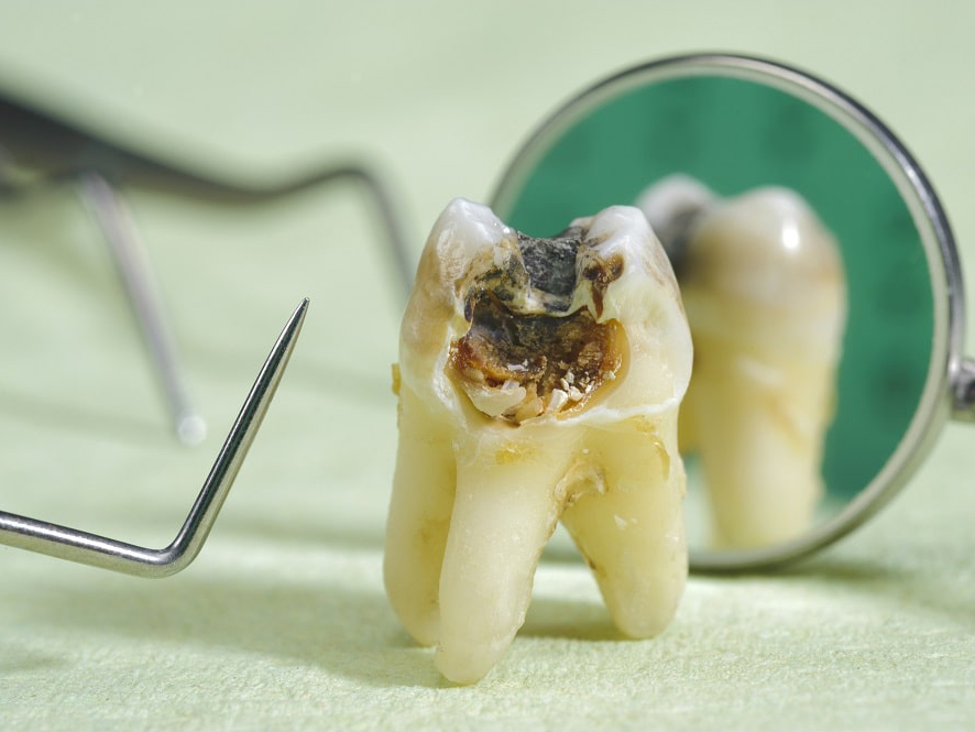 Đẩy lùi sâu răng hiệu quả nhờ biết cách chăm sóc răng miệng tại nhà